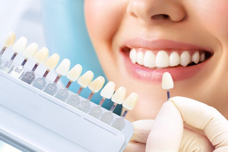 Dentist comparing a patient's smile with a dental shade guide for tooth whitening or veneer matching
