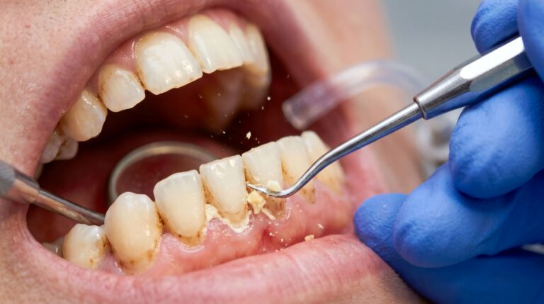 Hand scaler removing hardened calculus deposits from the lower front teeth during a dental cleaning.