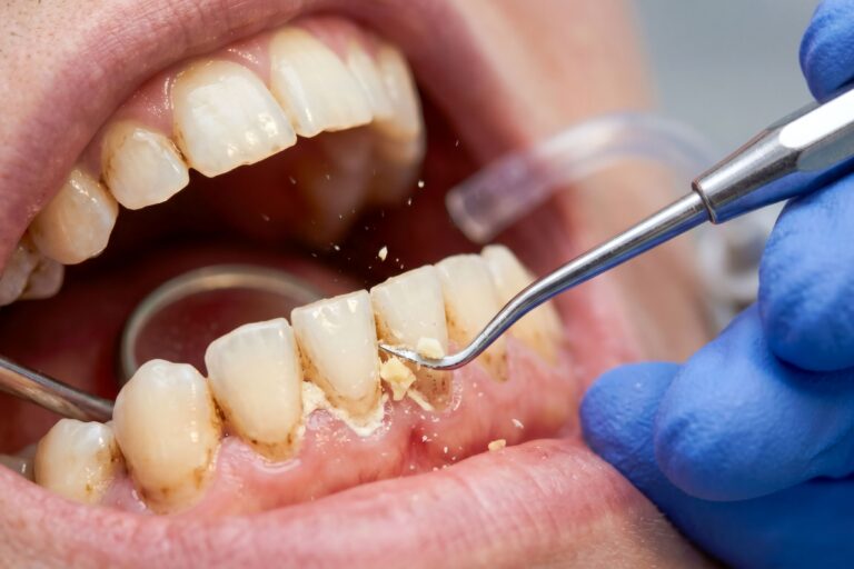 Hand scaler removing hardened calculus deposits from the lower front teeth during a dental cleaning.